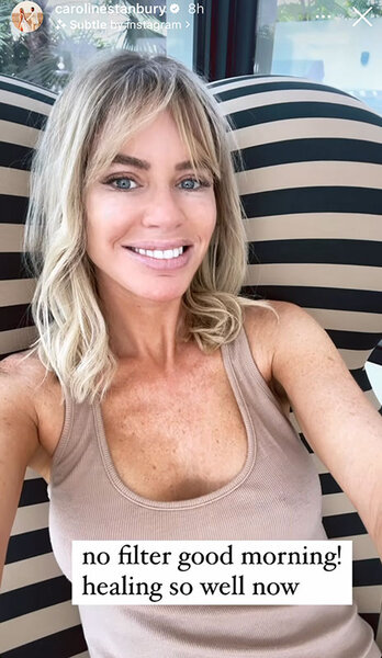 Caroline Stanbury smiling and showing the result of her facelift.