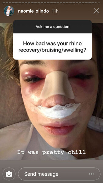 Naomie Olindo after her nose job