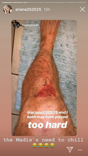 Jeremy Madix Softball Injury