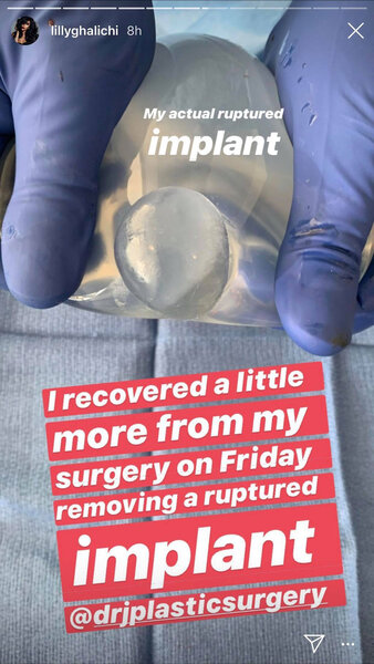 Lilly Ghalichi Implant Popped 01