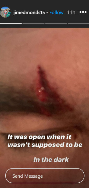 Jim Edmonds Injury Stitches Rhoc 03